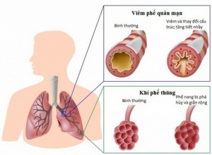 SKĐS – Bệnh phổi tắc nghẽn mạn tính (COPD) là tình trạng bệnh lý có thể dự phòng và điều trị được.
