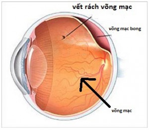 Tổn thương võng mạc_ biến chứng đáng sợ của bệnh tiểu đường