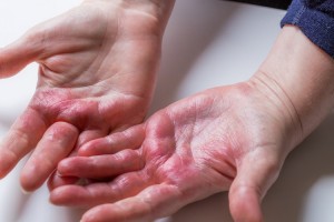 “3 ngứa, 2 đau” thực chất là triệu chứng ung thư gan giai đoạn đầu dễ bị bỏ qua nhất