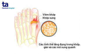 Bệnh gout cấp tính: Nguyên nhân, triệu chứng, chẩn đoán và điều trị